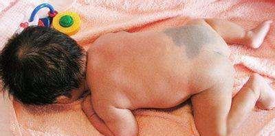 无色素痣|宝宝身上这3种“印记”,可能藏着疾病,发现了要及时去医院!