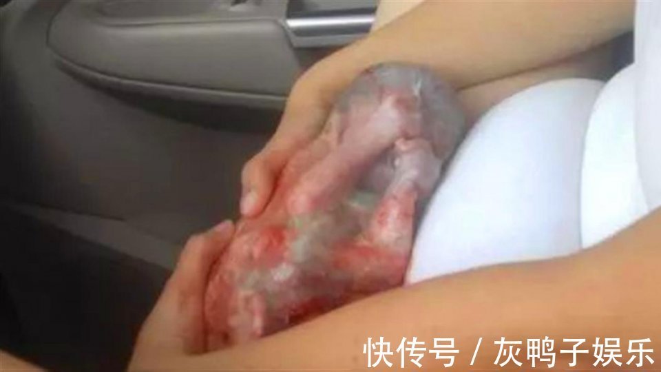 医生|生下“带壳宝宝”,产妇着急落泪,医生却高兴祝贺是好事