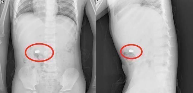 发育不良|5岁儿子开心得手舞足蹈,宝妈却傻了眼,抱着孩子冲进医院