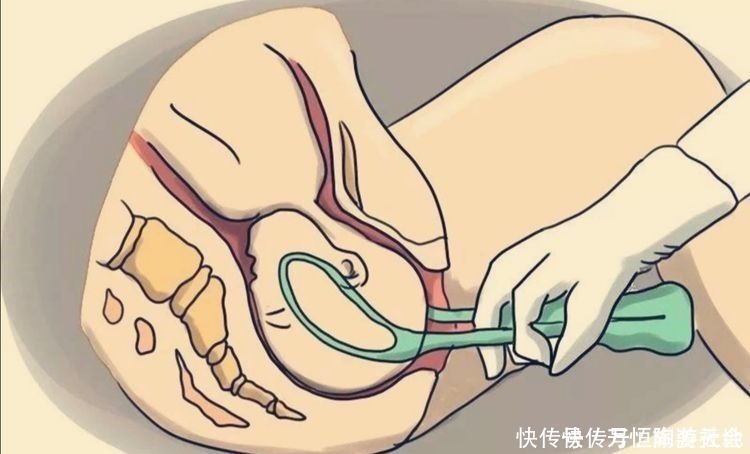 产钳术|产房内妈妈拼命为宝宝挡下产钳,爸爸却果断决定用!医生好老公