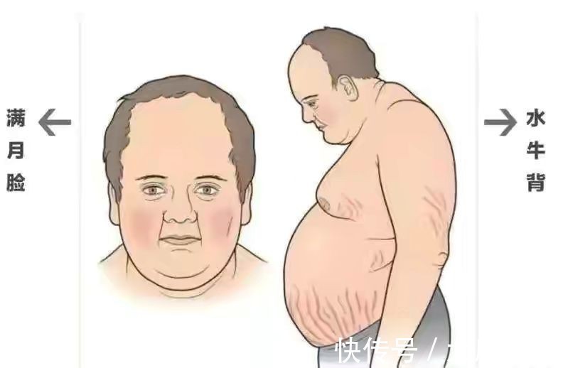 高血压|孕妇体重130斤!9.5斤“巨大儿”高血压、皮质醇增多症接踵而至