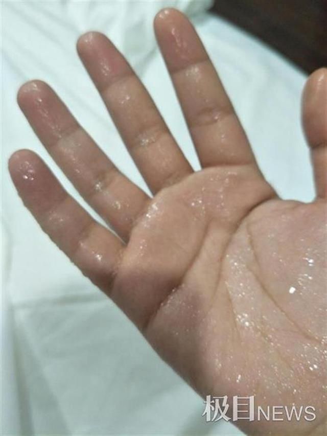 手汗症|女子双手总是湿哒哒甚至滴水，手术后终于告别“水手生涯”