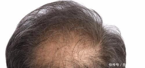 出现这5个现象，有可能会脱发每天5分钟，让毛囊恢复掉发回来