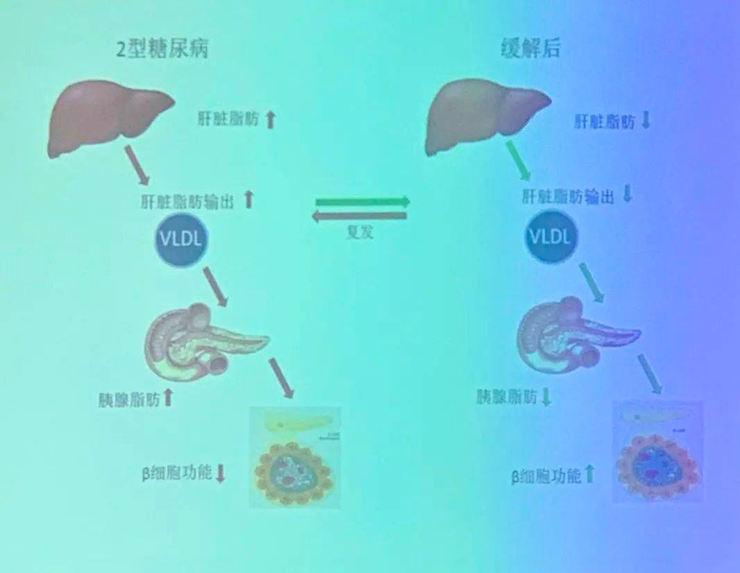 2型糖尿病|2型糖尿病 竟然能逆转?这两点是关键