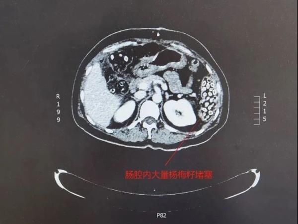 icu|吃楊梅不吐核？幾十顆下肚，長沙一阿姨住進(jìn)ICU……