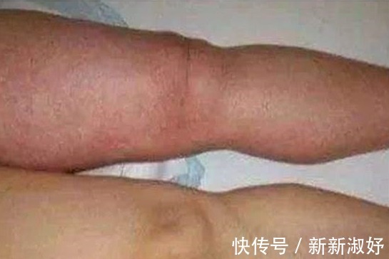 癌细胞|有没有癌，“腿”知道，若有以下3种异常，也许是癌细胞来访