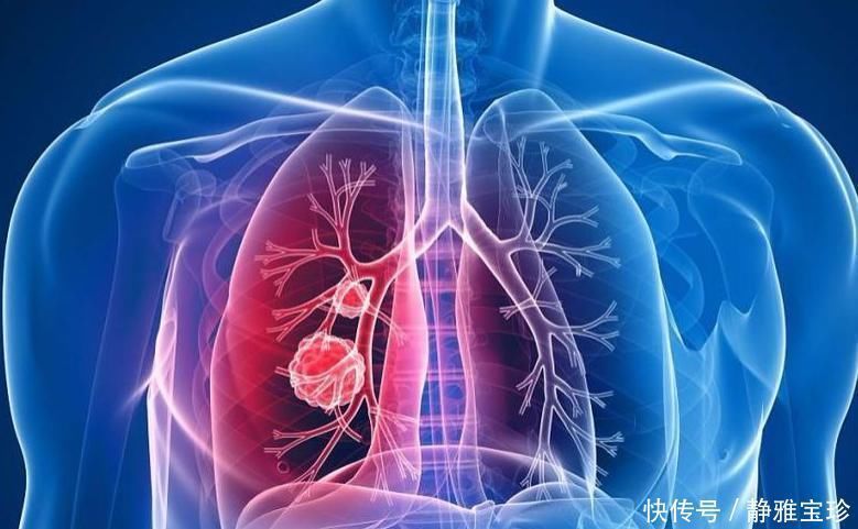 环境生活|体检查出肺部结节,会引发肺癌吗3个答案先让你放心