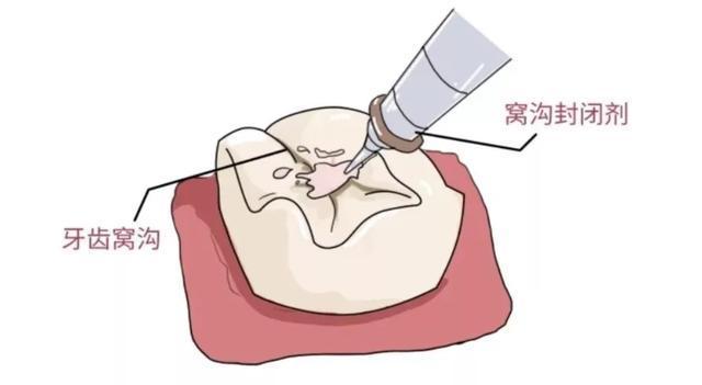 恒牙|4岁男孩牙齿几乎全黑6岁前,不要让孩子自己刷牙!