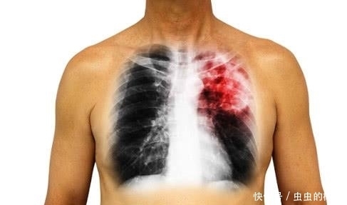 持续|身体持续出现4个症状,需警惕,或是肺癌“来袭”!