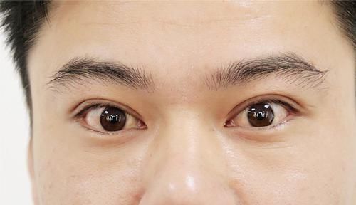 肿瘤|肿瘤医生:身体频繁有3个迹象,或是甲状腺癌“一级预警”