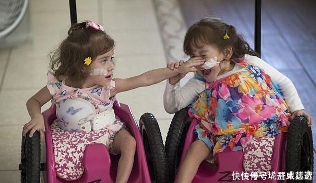 父母|连体双胞胎做分离手术成功,每人分得一条腿,父母喜极而泣!