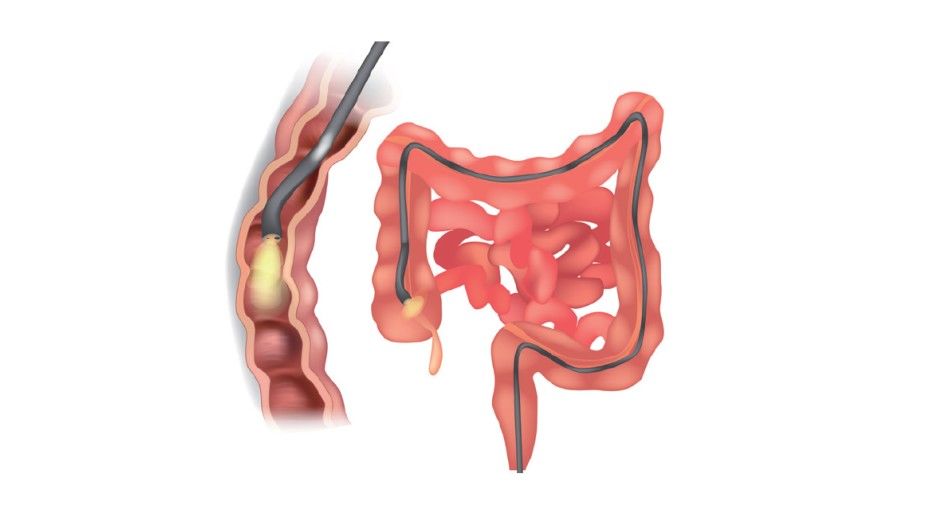 诊断性|体检查出便便有血就是肠癌吗？身体出现哪些症状要警惕结直肠癌？
