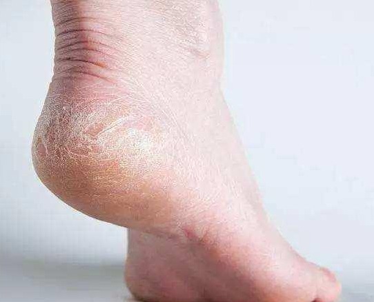 水肿|如果你的肾坏了,脚上就会有四种表现,如果没有,恭喜你肾是好的