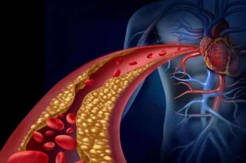 高血脂|甘油三酯偏高就是高血脂了？提醒：若未超过这个数，或无需担心