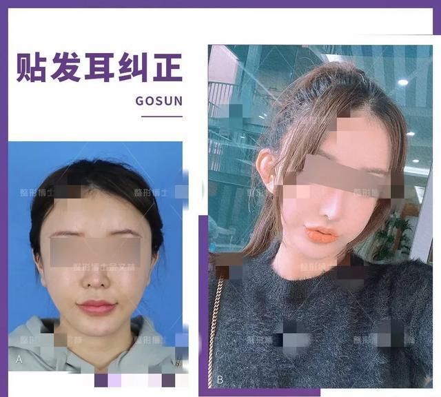 整容|医生，我耳朵不够精灵