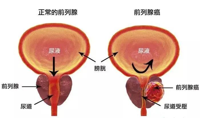 瞿大爷|4小时40分钟，拿下两处恶性肿瘤