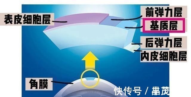 近视|个性化飞秒激光近视550度+散光500度如何恢复到10视力