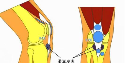 肿胀|膝关节肿胀、积液、还伴疼痛,是啥原因引发的?该咋办?请看此文