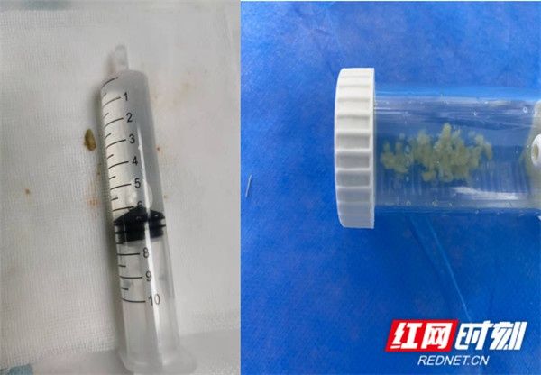 异物|永州市中心医院温馨提醒：警惕气管异物，家长不可掉以轻心！