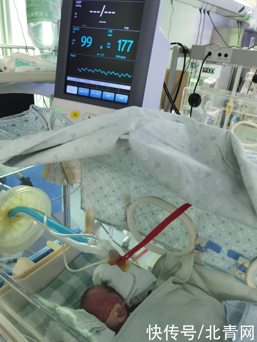 早产|在封闭区产房，三分钟抢回早产儿生命