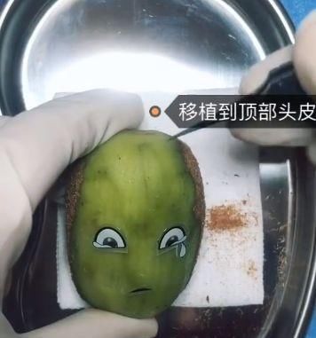 手术|给火龙果割阑尾33岁水果医生爆红吸粉90万网友看到第一个就痛了