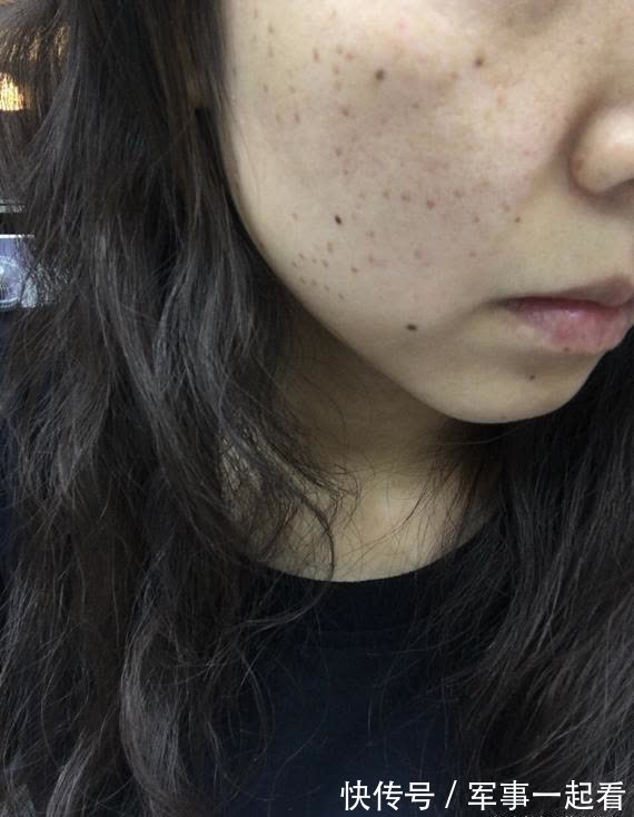 血管堵塞|血脂偏高的人,头部或有4个表现,若想调节血脂,给你2个小建议