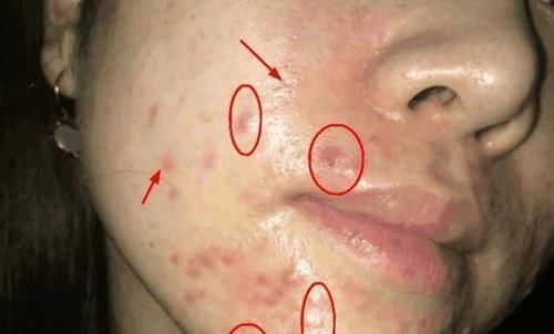 越来越|毛孔越来越大,是螨虫把你的脸当成寄宿地,3个方法教你摆脱困扰