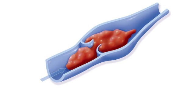 血管堵塞|血栓的“克星”找到了,每天多吃点,血栓可能与你“分道扬镳”