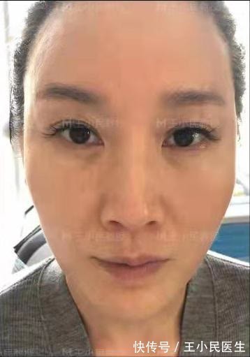 法令纹 拉皮除皱王小民教授:46岁的她选择了小拉皮手术,看看效果反馈!