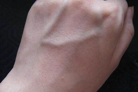 皮下脂肪|手上青筋越明显说明身体越差?今天就给大家科普一下!