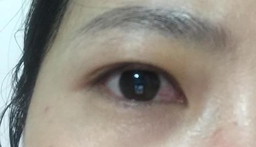 肝脏|肝脏变硬了,头部或会发出“呼救信号”,及时发现,或还能逆转