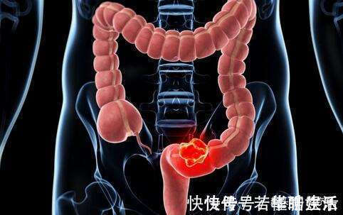 大肠癌|一天三次大便，与三天一次大便相比，哪个更容易得大肠癌