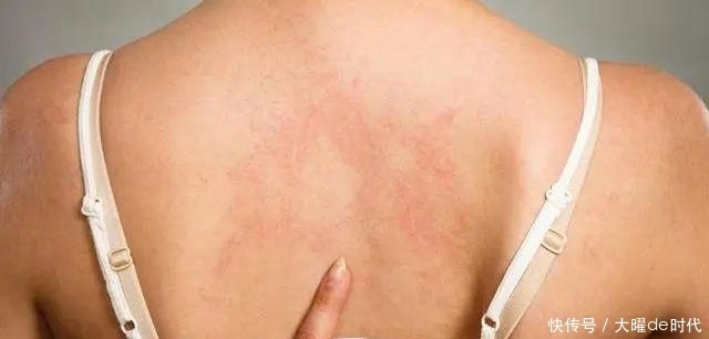 胸前背后总是长痘痘该怎么办?