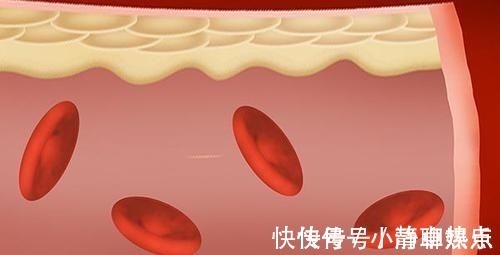 预防心血管疾病|血脂高不能吃肉医生:3种肉适量吃,有助降脂,防止动脉硬化