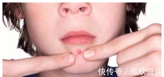 伤口|将痘痘挤破了之后,该怎么处理才不会留疤?可别做错了