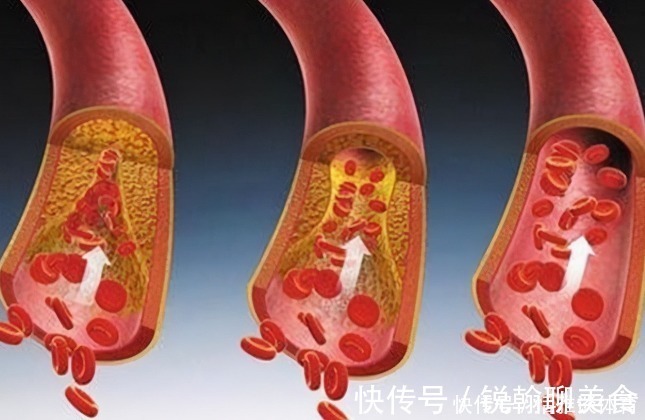 组织细胞|怎么知道“血管堵没堵”?教您几个方法,轻松解决,很实用