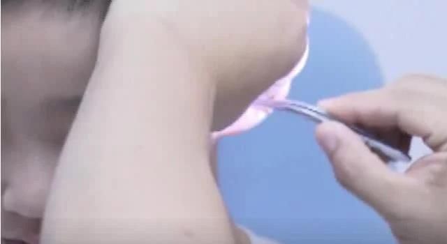 耵聍|五岁男孩出生起就没有掏过耳垢结果他第一次掏,花了5000元