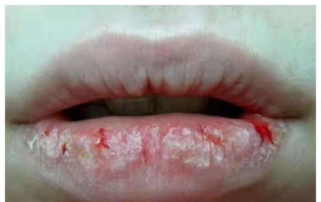 润唇膏|冬季孩子嘴唇起皮、干裂还出血?三招教你正确护理,光喝水没用