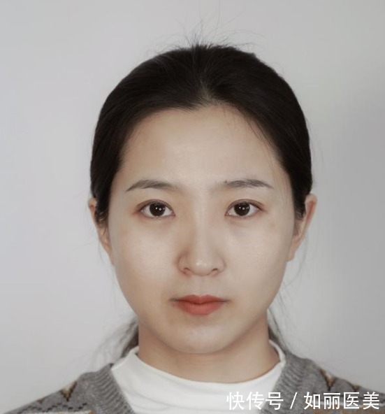 切口 双眼皮越宽眼睛就越大吗?医生揭开双眼皮手术的5个“真相”!