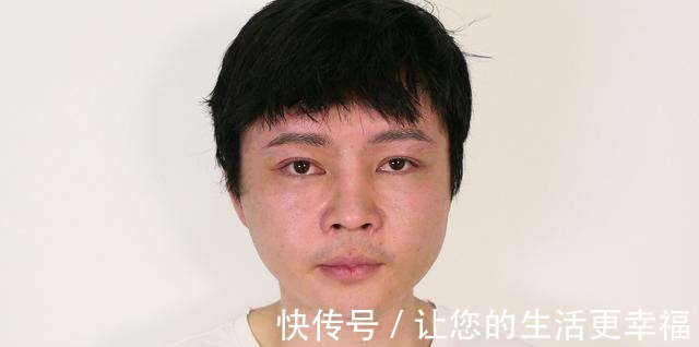 法令纹 32岁小伙子拉皮真实记录，术后30天效果很“惊艳”！