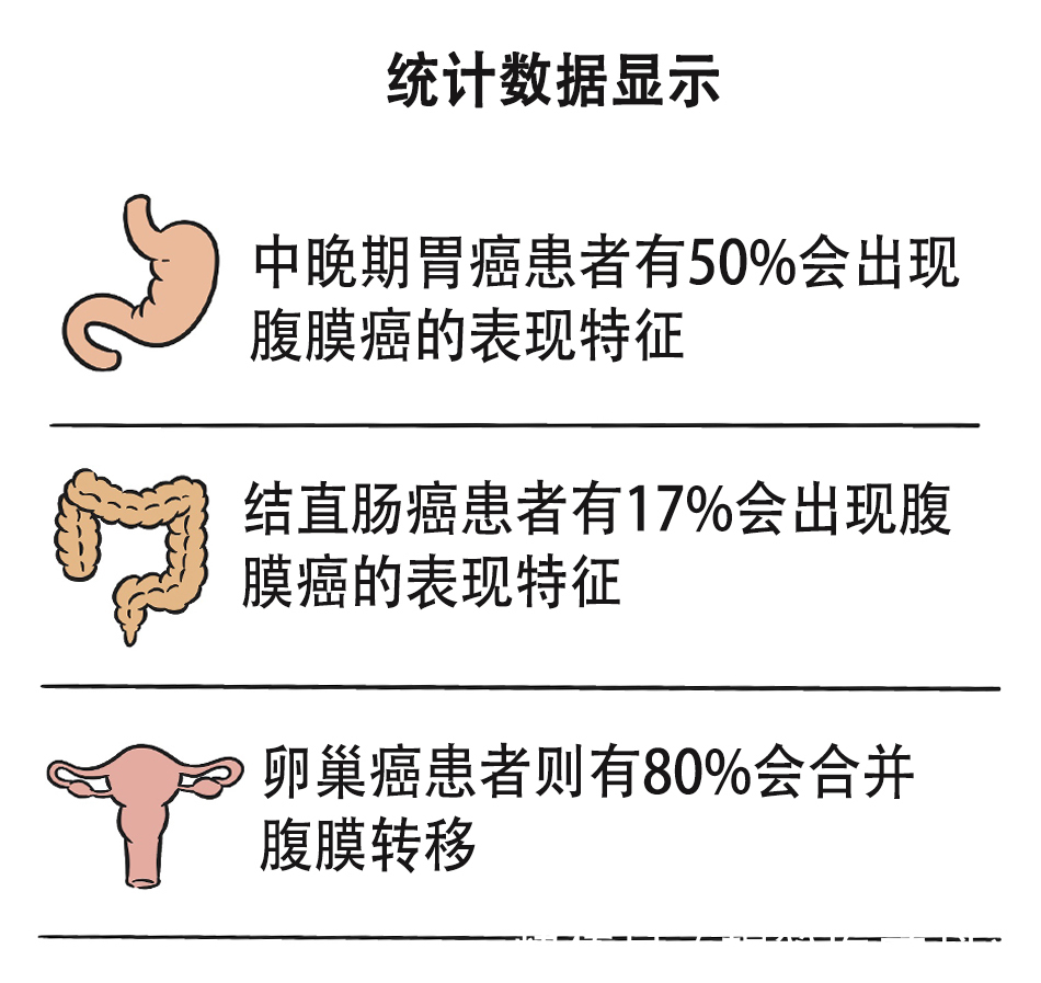 李雁|“老大难”腹膜癌能治吗？