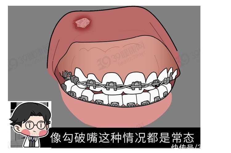 矫正|为什么只要戴牙套，牙齿就可以恢复得很整齐？生动展示矫正过程