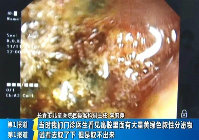 塞进|33个月宝宝电池塞进鼻子，鼻腔黏膜糜烂……