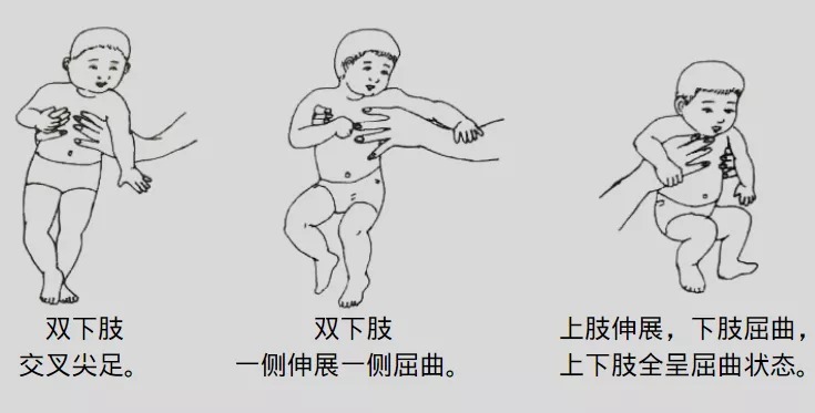 孩子|脑瘫孩子的治疗越早越好,怎么能早期发现孩子的异常呢?