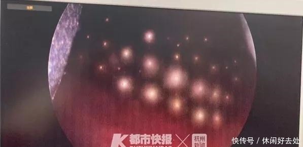 11岁男孩将70颗磁力珠塞尿道，医生呼吁别给孩子买了！