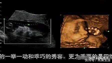 畸形|四维彩超能够预防胎儿畸形吗？四维彩超真正有6个作用，别搞错