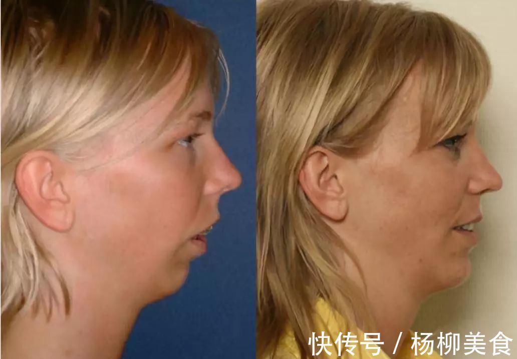 呼吸道|女儿被同学嘲笑像“青蛙”,妈妈没当一回事,朋友提醒才带去检查