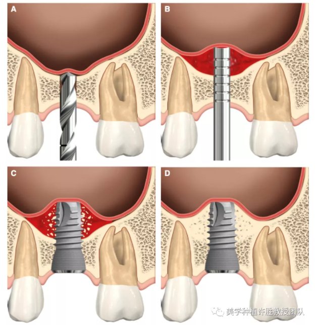 骨量|上颌后牙区骨量不足？上颌窦外提升帮助你！