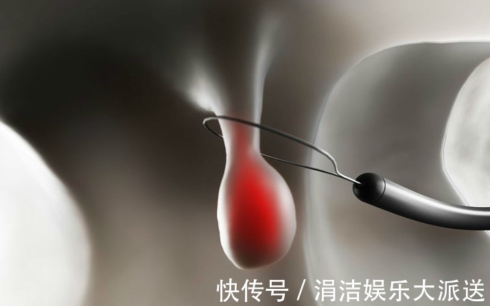 管状腺瘤|两种息肉一定要及时切除，拖五年以上很可能变成恶性肿瘤