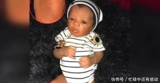 胎记|双胞胎姐姐在腹中被“吸收”,化为胎记留在弟弟腿上,令人动容